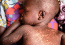 Measles Outbreak Claims Over 30 Lives in Northeastern Uganda